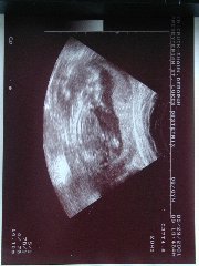 Click to see Debbie_ultrasound.jpg